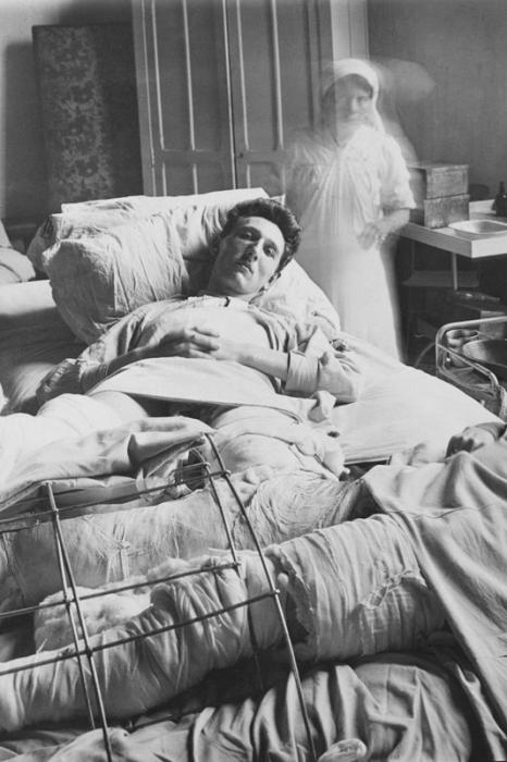 Hôpital du Grand-Palais. Opération de la greffe osseuse, les deux opérés deux jours après l'opération.